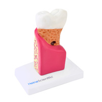 Zahnmodell mit Erkrankungen Heinescientific (1 Stück) , Detailansicht