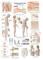 Anatomische Lehrtafel Osteoporose Erlerzimmer 50 x 70 cm Kunstdruckpapier mit Beleistung (1 Stück), Detailansicht
