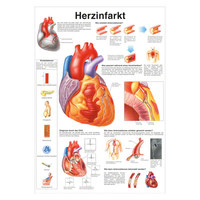 Herzinfarkt Poster Anatomie 70x50 cm medizinische Lehrmittel, Nicht Laminiert